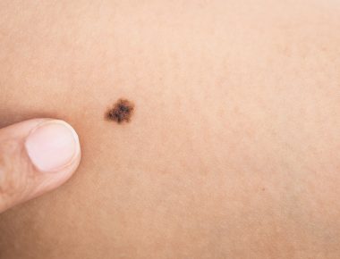 Macro black birthmark on skin